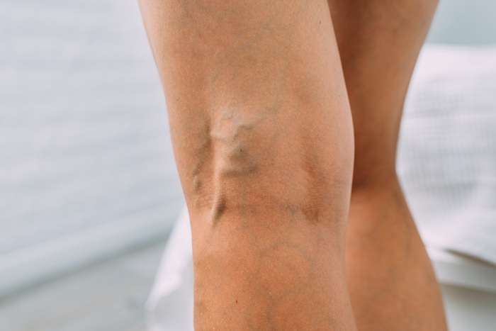 womans legs with varicose veins